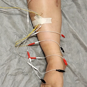 الکترو آکیوپانچر و طب سوزنی